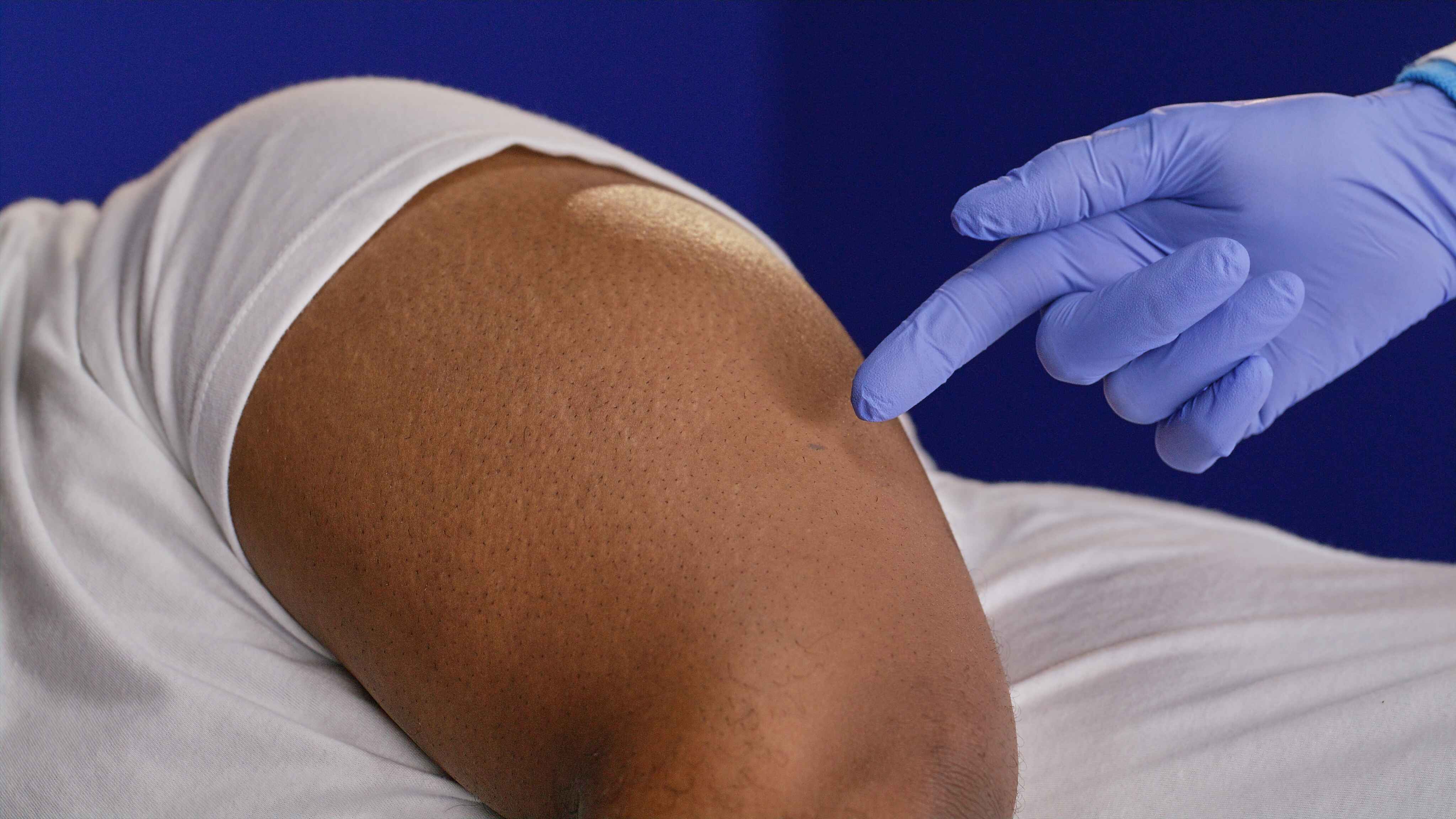 Gloved hand of a healthcare provider points to a marked area on a patient’s upper arm where the Eversense CGM sensor will be inserted.